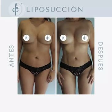Slider image (4) Dr. Felipe Castro Esguerra - Plastic Surgeon in Colombia